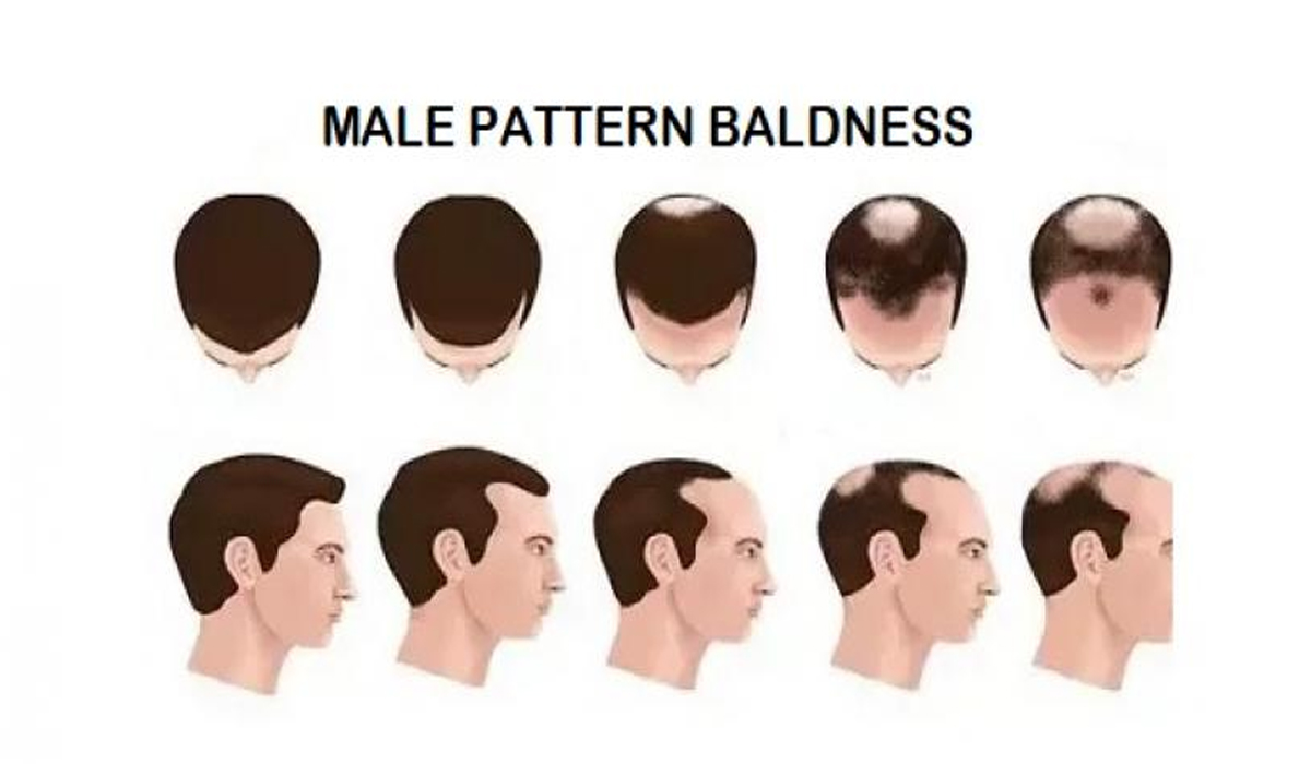 Effectiveness Of Using Finasteride For Male Pattern Baldness